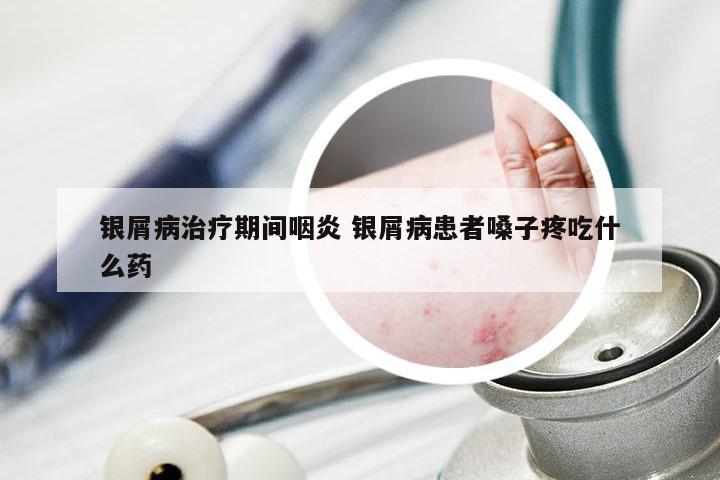 银屑病治疗期间咽炎 银屑病患者嗓子疼吃什么药