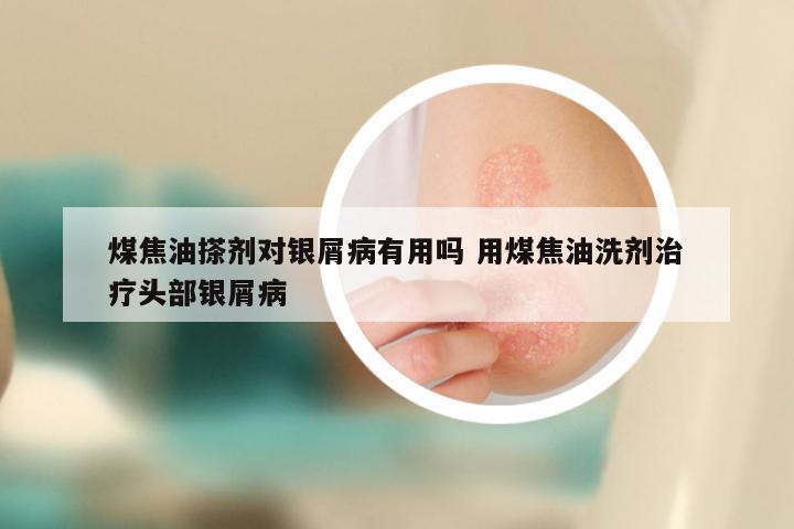 煤焦油搽剂对银屑病有用吗 用煤焦油洗剂治疗头部银屑病