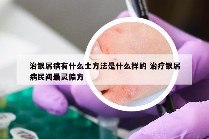 治银屑病有什么土方法是什么样的 治疗银屑病民间最灵偏方