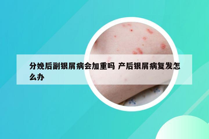 分娩后副银屑病会加重吗 产后银屑病复发怎么办