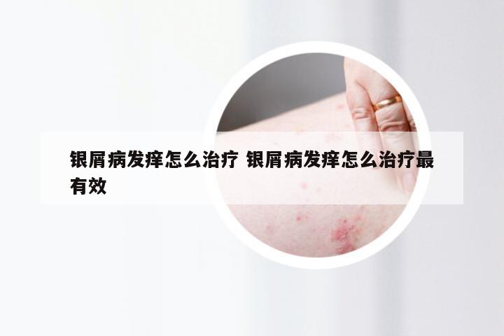 银屑病发痒怎么治疗 银屑病发痒怎么治疗最有效