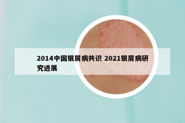 2014中国银屑病共识 2021银屑病研究进展