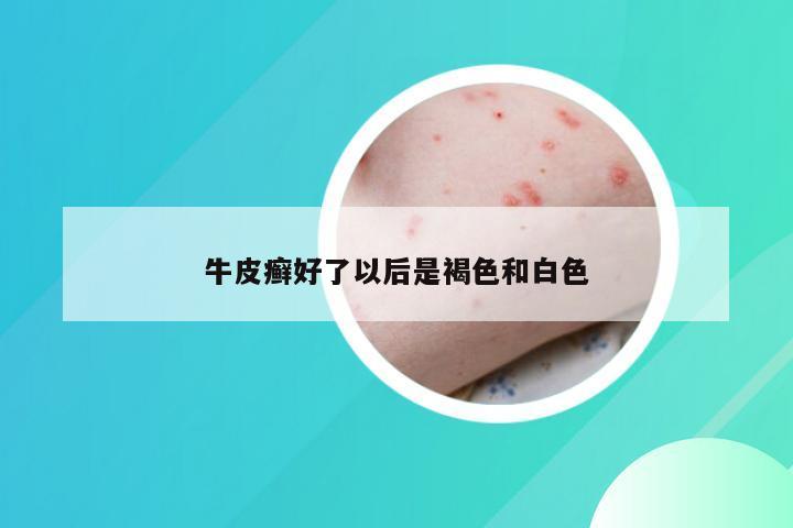 牛皮癣好了以后是褐色和白色