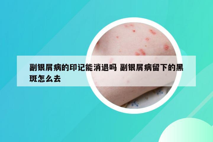 副银屑病的印记能消退吗 副银屑病留下的黑斑怎么去