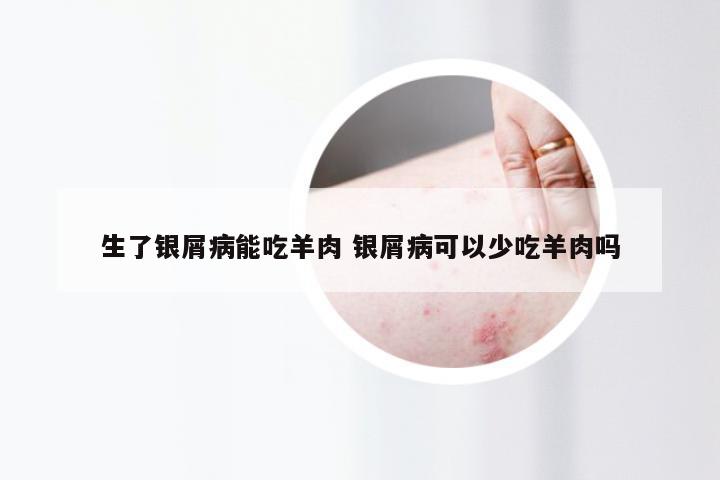 生了银屑病能吃羊肉 银屑病可以少吃羊肉吗