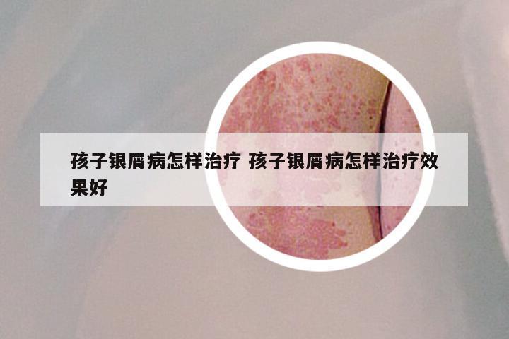 孩子银屑病怎样治疗 孩子银屑病怎样治疗效果好