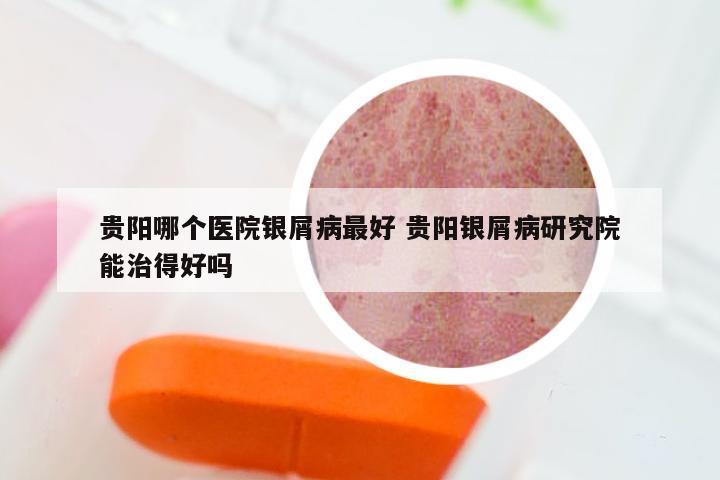 贵阳哪个医院银屑病最好 贵阳银屑病研究院能治得好吗