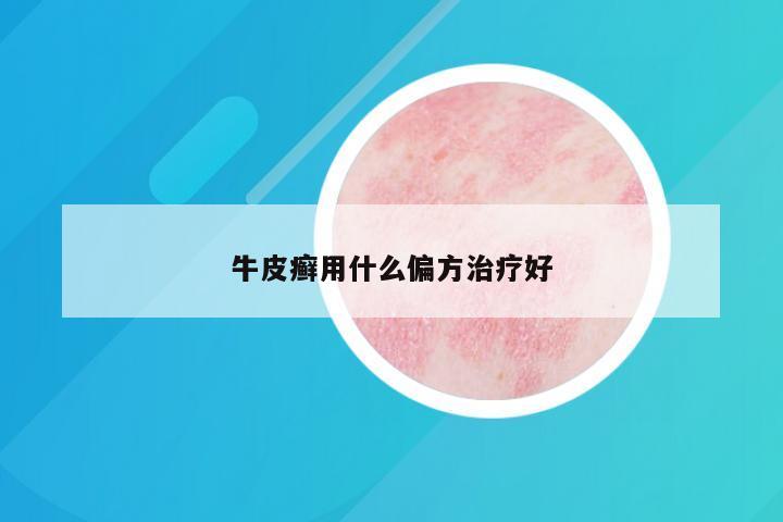 牛皮癣用什么偏方治疗好