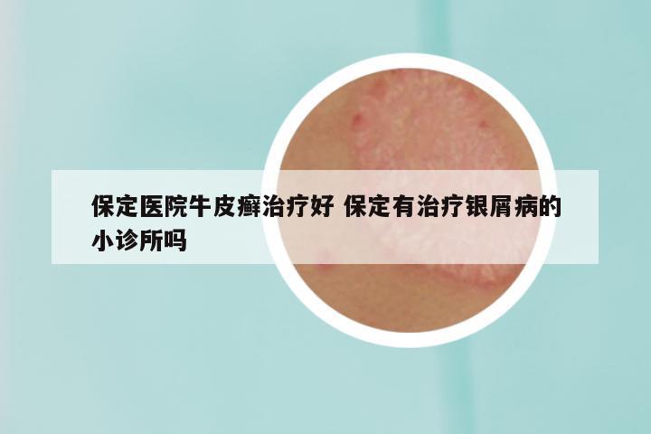 保定医院牛皮癣治疗好 保定有治疗银屑病的小诊所吗