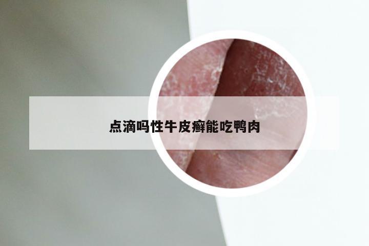 点滴吗性牛皮癣能吃鸭肉