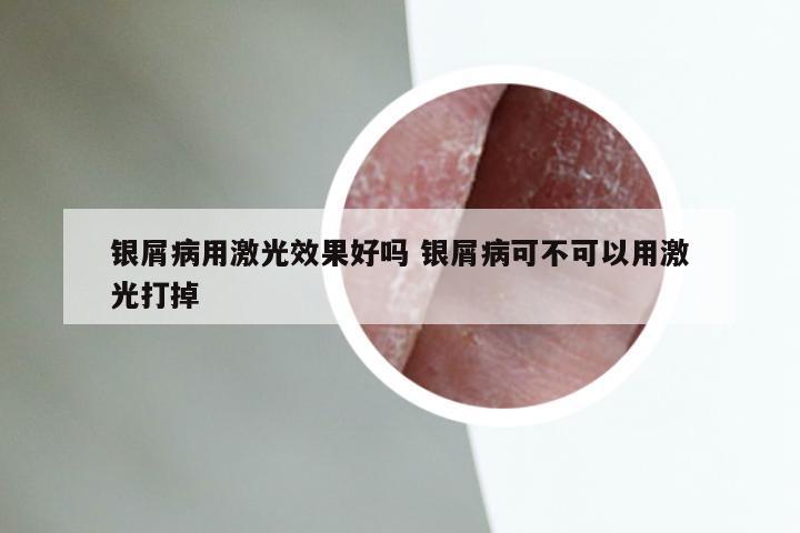 银屑病用激光效果好吗 银屑病可不可以用激光打掉