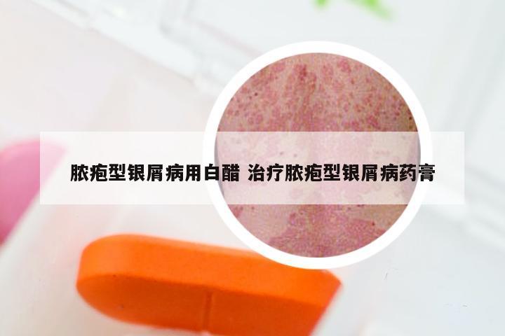 脓疱型银屑病用白醋 治疗脓疱型银屑病药膏