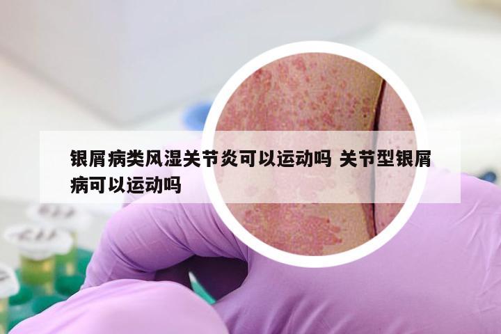 银屑病类风湿关节炎可以运动吗 关节型银屑病可以运动吗