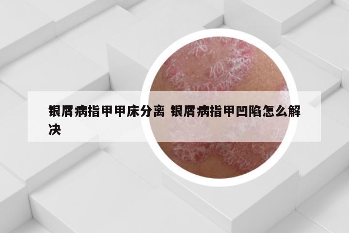 银屑病指甲甲床分离 银屑病指甲凹陷怎么解决