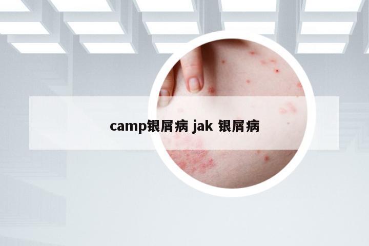 camp银屑病 jak 银屑病