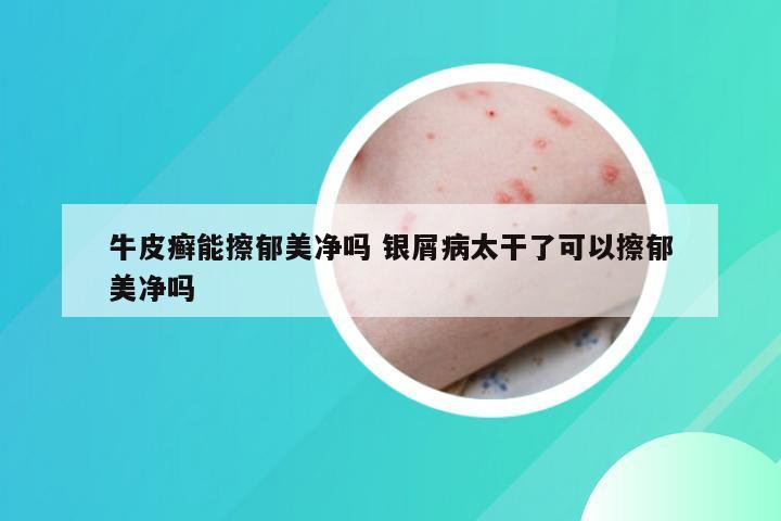 牛皮癣能擦郁美净吗 银屑病太干了可以擦郁美净吗