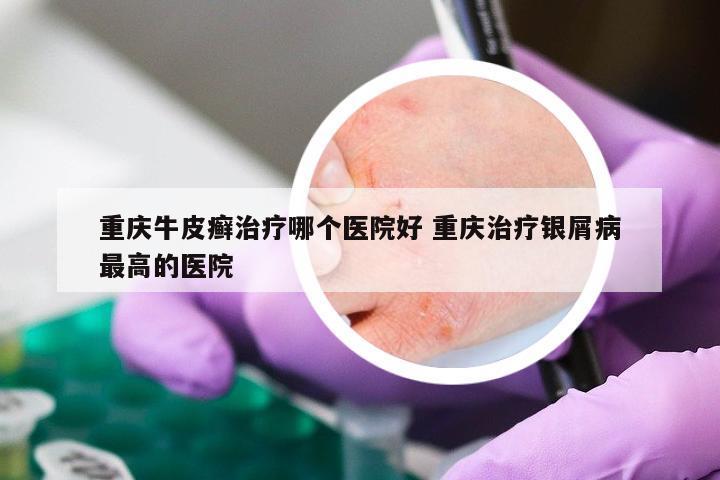 重庆牛皮癣治疗哪个医院好 重庆治疗银屑病最高的医院