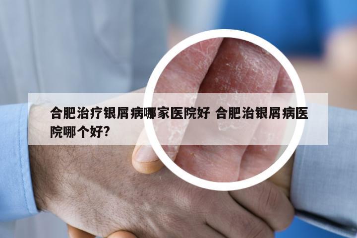 合肥治疗银屑病哪家医院好 合肥治银屑病医院哪个好?