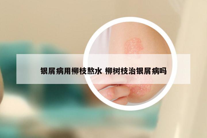 银屑病用柳枝熬水 柳树枝治银屑病吗