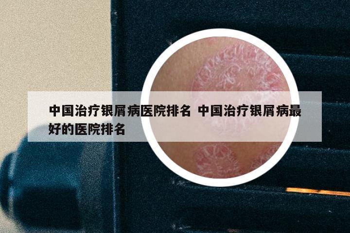 中国治疗银屑病医院排名 中国治疗银屑病最好的医院排名