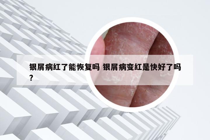 银屑病红了能恢复吗 银屑病变红是快好了吗?