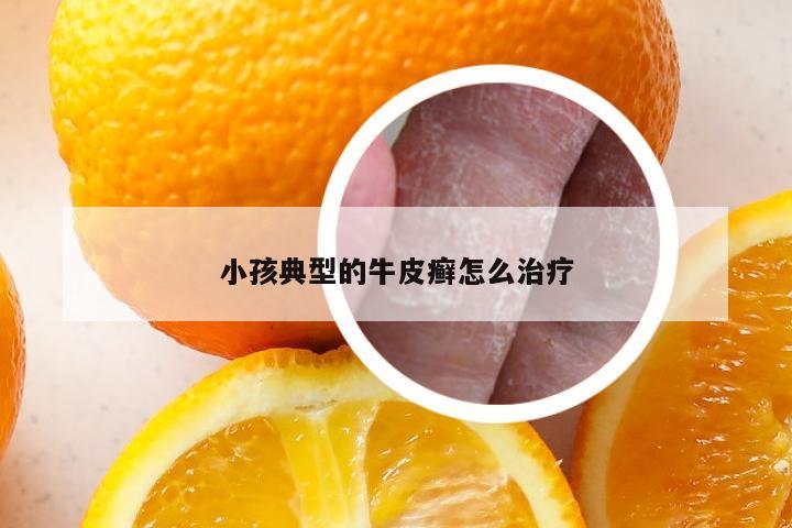 小孩典型的牛皮癣怎么治疗