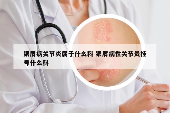 银屑病关节炎属于什么科 银屑病性关节炎挂号什么科