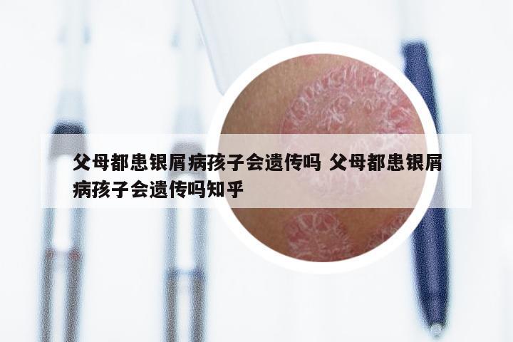 父母都患银屑病孩子会遗传吗 父母都患银屑病孩子会遗传吗知乎